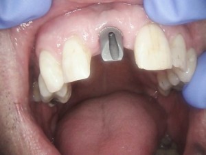implant screw picture